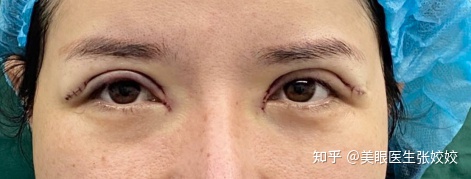 埋线双眼皮两边不对称怎么办,埋线双眼皮不对称修复方法