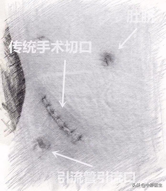 一个切口的阑尾炎手术,阑尾炎微创肚脐部位有个洞
