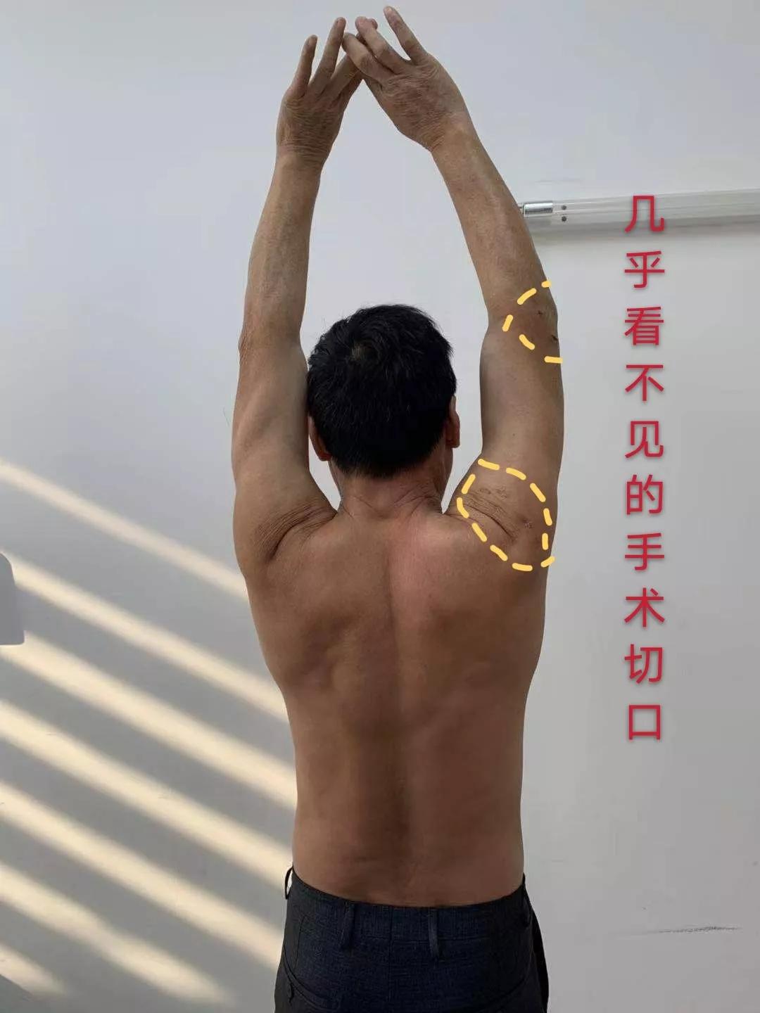 肩袖损伤肘关节旋转康复训练,肩关节损伤治疗微创视频