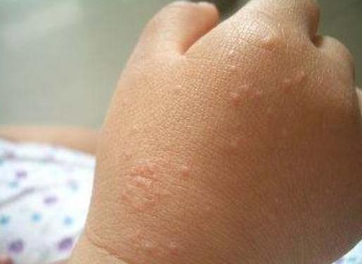 医生有阴虱是怎么回事,男性下身有虫子不治可以吗