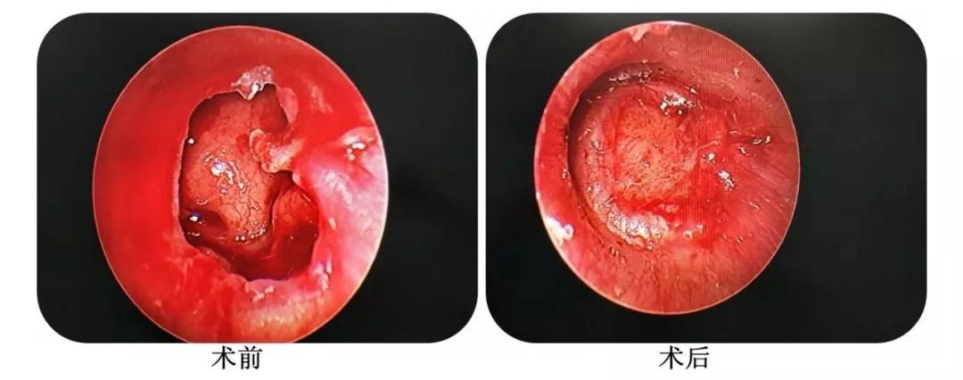 耳朵流脓听力下降耳鸣,耳朵反复流脓听力下降需要手术吗