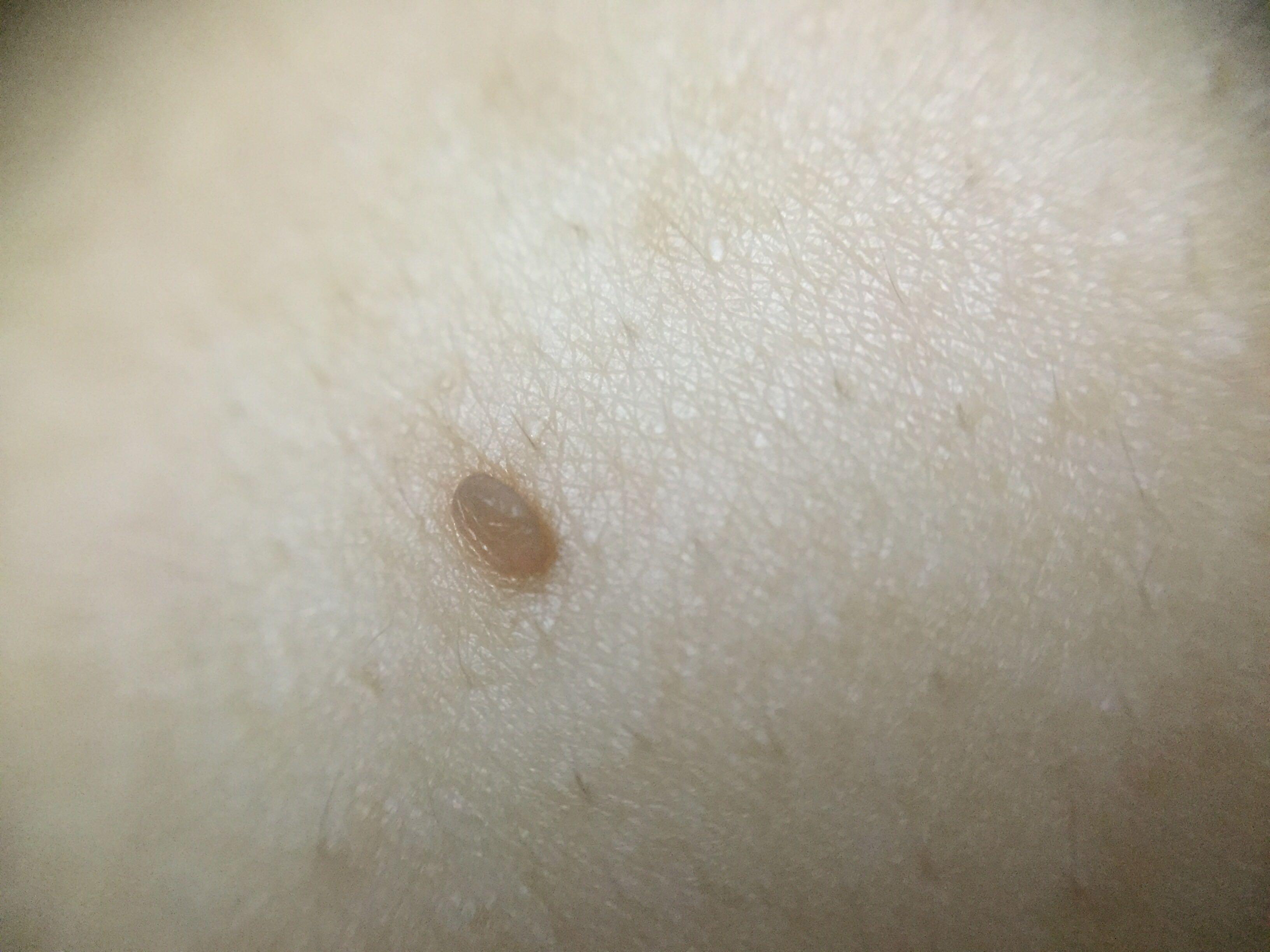 颈部上的小肉球如何处理,颈部突然长了个小疙瘩是怎么回事