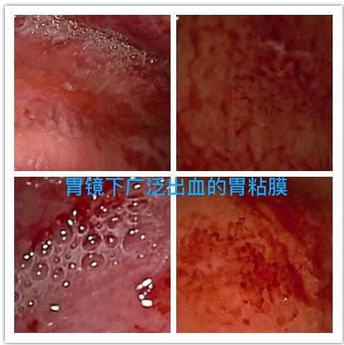 6个月宝宝消化道出血症状,6个月宝宝吐血怎么回事