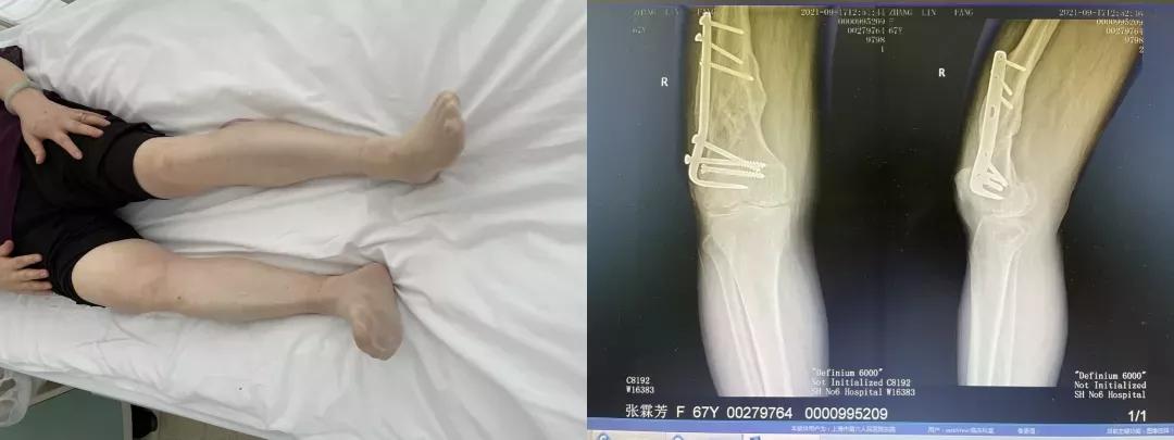 计算机导航下全膝关节置换，精确定位手术“生命线”