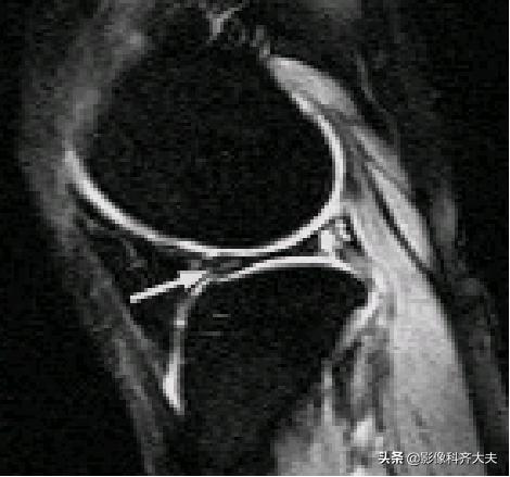 膝关节半月板损伤的磁共振,膝关节半月板病变的mri诊断与鉴别