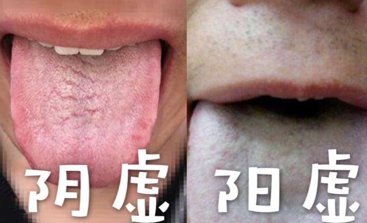 肾阴虚和肾阳虚的表现和区别,肾阴虚和肾阳虚怎么正确判断