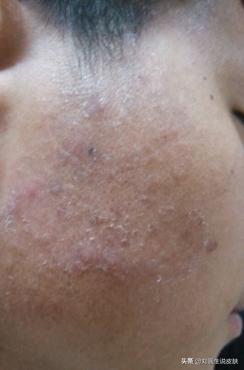 错把体癣当湿疹怎么办,错把湿疹当癣治疗越来越严重