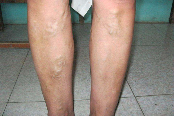 静脉曲张是什么？什么人群容易发作？如何减少腿上的“小蚯蚓”？