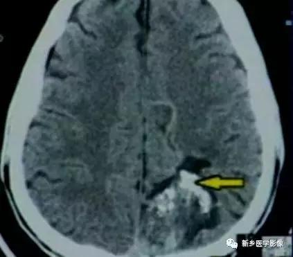 颅内有钙化怎么治疗,34岁脑部有钙化正常吗
