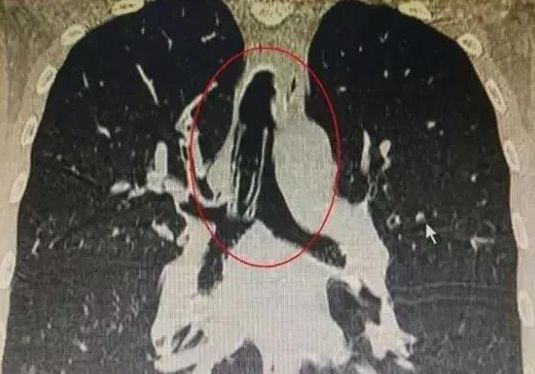 打火机在手里爆了怎么办,打火机咬爆了会崩嘴吗