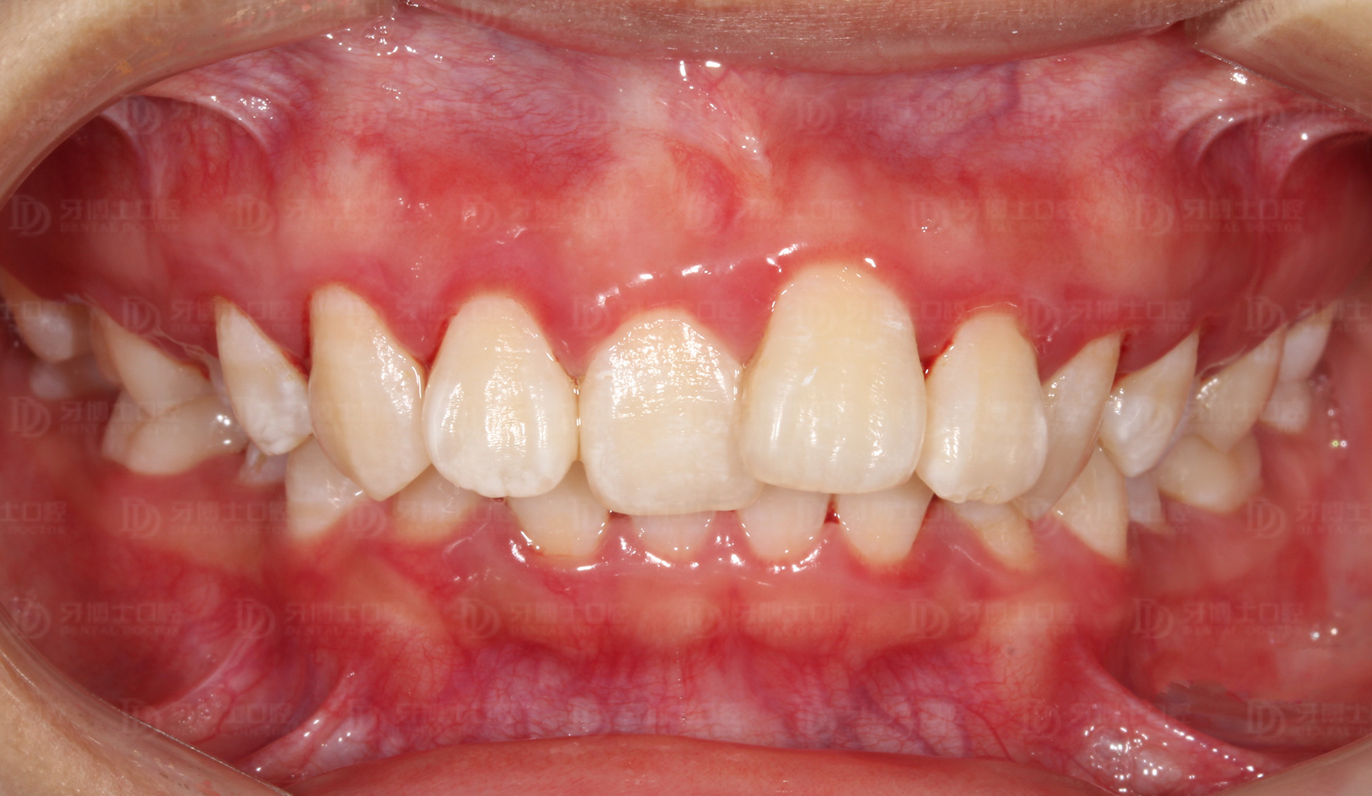 八岁孩子牙齿不齐用什么矫正,十岁小孩牙齿不齐需要矫正吗