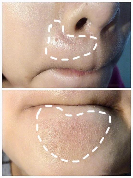 女生闭口粉刺怎么办,有闭口粉刺做什么医美