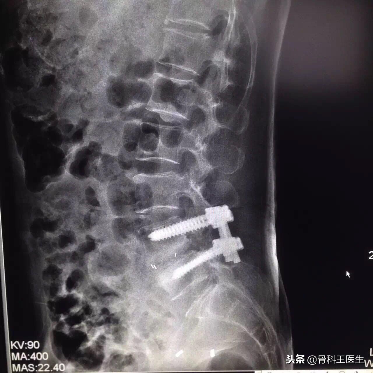 腰椎滑脱可以复位吗,第四腰椎向前滑脱1度可以复位吗
