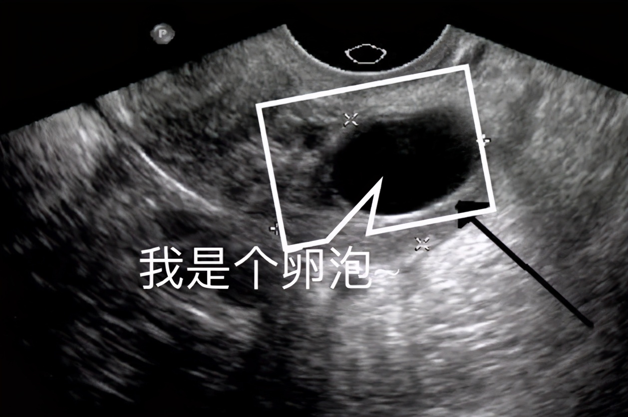 囊肿囊壁厚薄不均,囊肿卵泡分不清