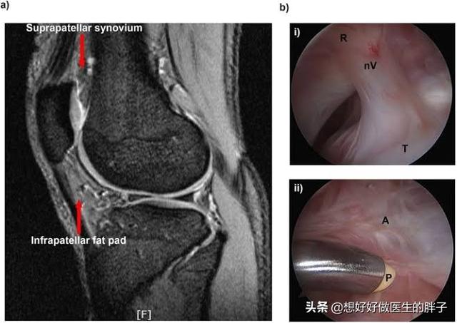 膝关节术后粘连药物治疗,膝关节手术后粘连最好的解决方法