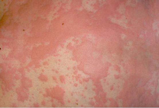 人工荨麻疹皮肤划痕症怎么治,人工荨麻疹皮肤划痕症怎么治疗