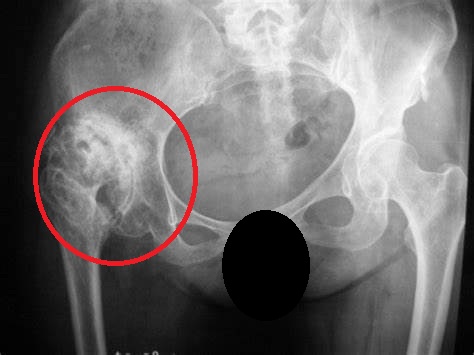 髋关节发育不良吃什么药效果最好,轻微髋关节发育不良可以不治疗吗