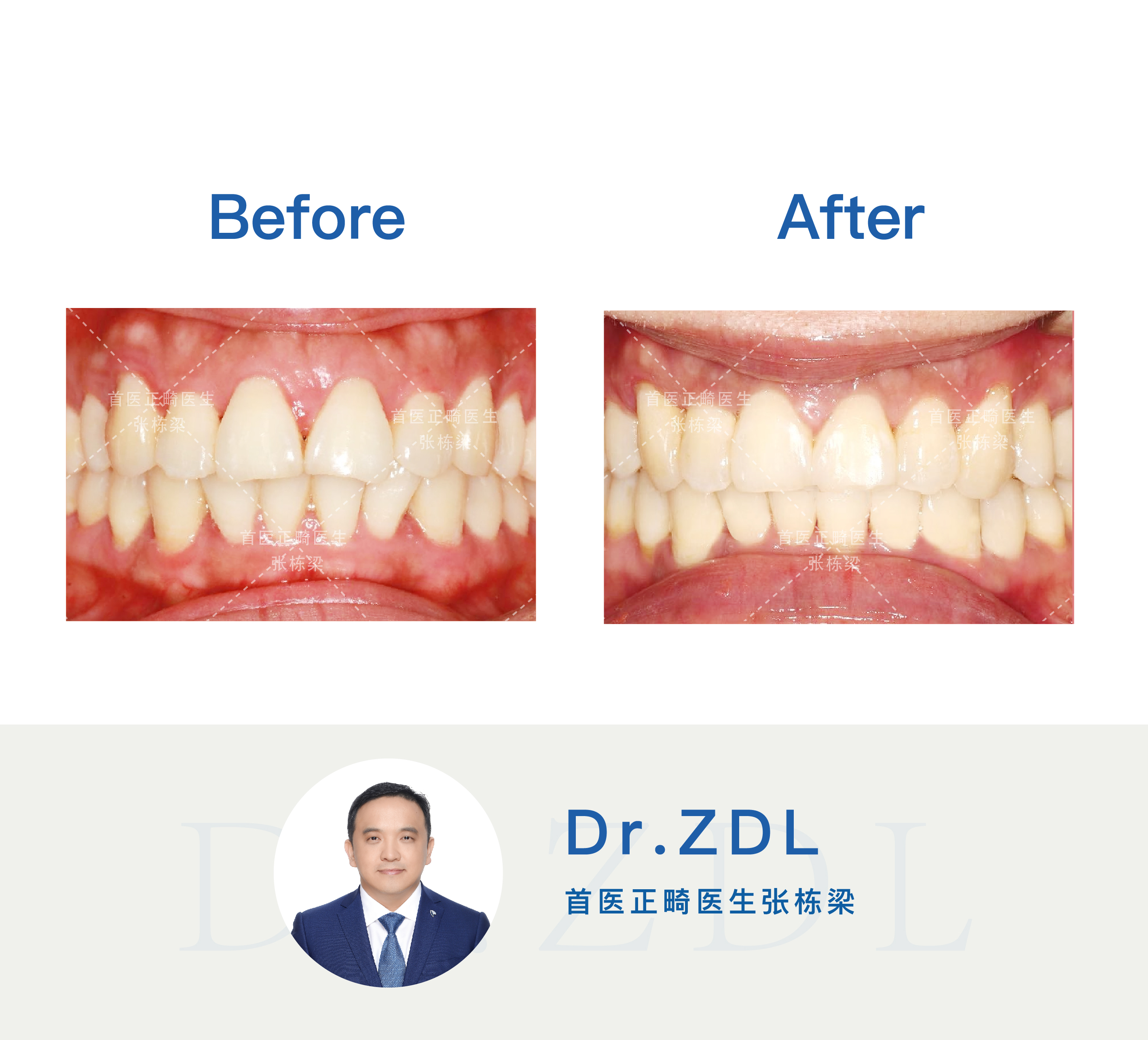 嘴突不做牙齿矫正后果,嘴突没有龅牙可以修复吗