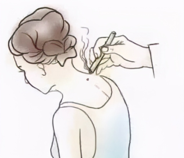 脖子后面的夺命包图片,脖子上有小包包是怎么回事