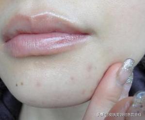 反复长痘留下顽固痘印用什么精华,顽固痘印如何祛除最有效果的方法