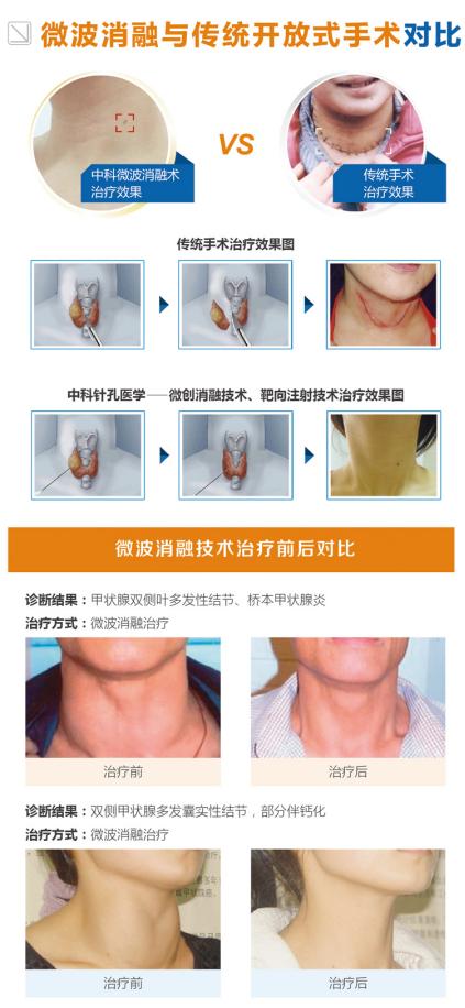 为什么肿瘤患者都拒绝做穿刺活检,穿刺活检恶性还能手术吗