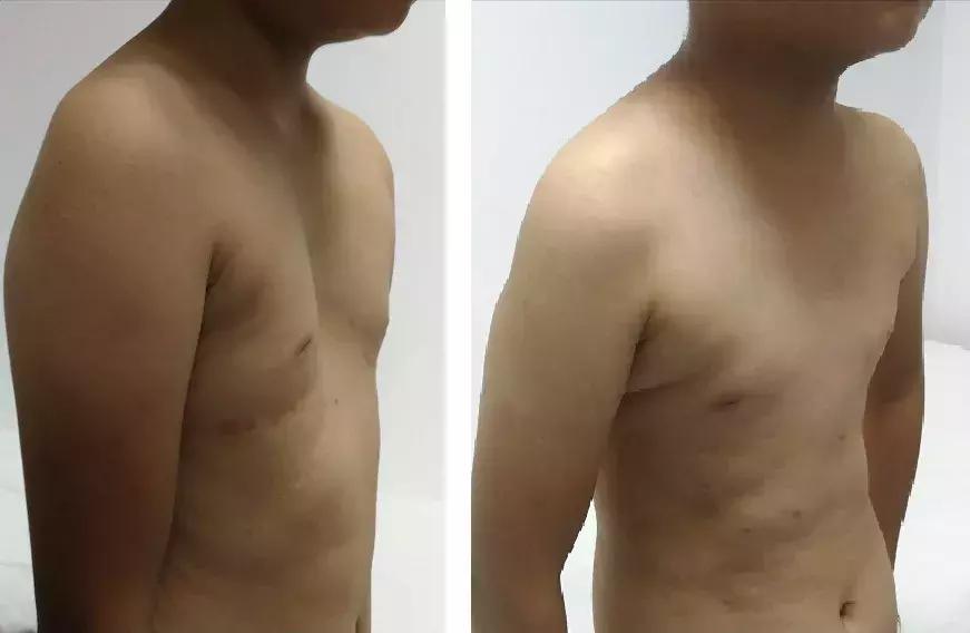 「拿掉」胸上的「漏斗」，让这个孩子挺起胸膛