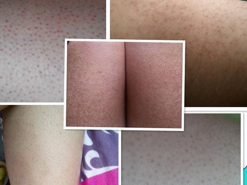 希尔芙课堂：鸡皮肤是怎么形成的？该如何淡化，小办法值得看