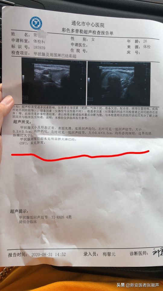 甲状腺b超4a癌变几率有多高,甲状腺4a中医治疗方法有效吗