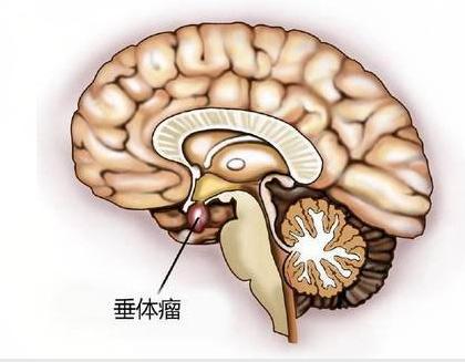 溴隐亭能彻底治疗脑垂体瘤吗,吃溴隐亭能缩小垂体瘤吗