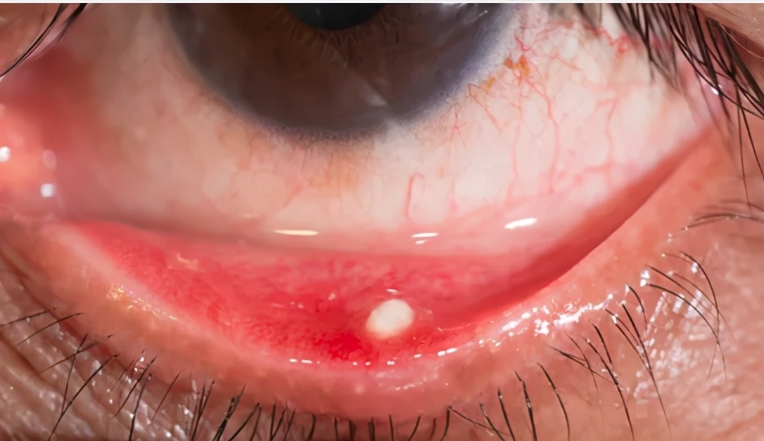 眼睛总感觉磨得慌还流泪,眼睛总觉得磨得慌怎么回事