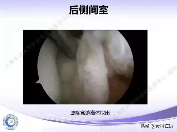 肘关节镜手术后引流,肘关节镜微创手术