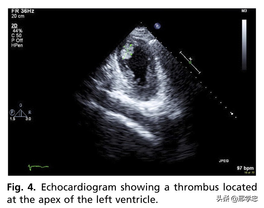 应激性心肌病搭桥,应激性心肌病反复