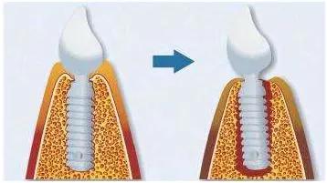 牙槽骨过度发育老了会怎么办,中国年轻人牙槽骨萎缩严重