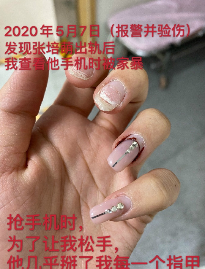 女方指甲折断，男方蛋蛋抓伤，张漠寒张培萌互指家暴，细节揪心