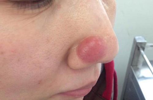 脸上长痘的几种原因,脸上长痘的三种原因