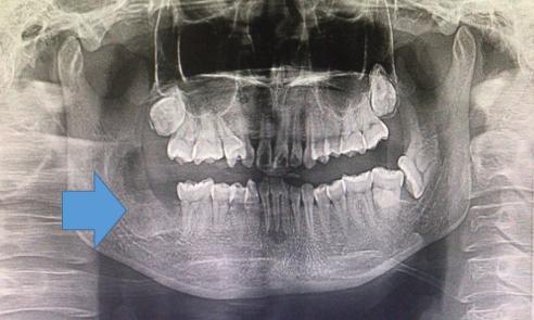 颌骨空洞是肿瘤吗,牙根部发现有个黑洞