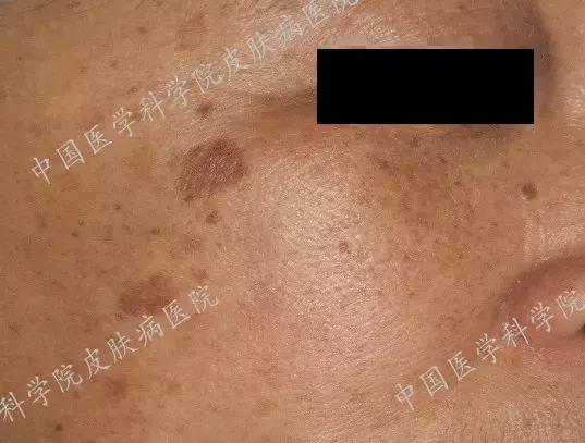 什么护肤品对晒斑有效,角质层薄有晒斑用什么护肤品