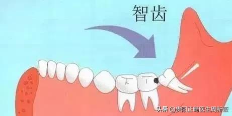 「科普」还在纠结是否拔智齿？看完你就明白了