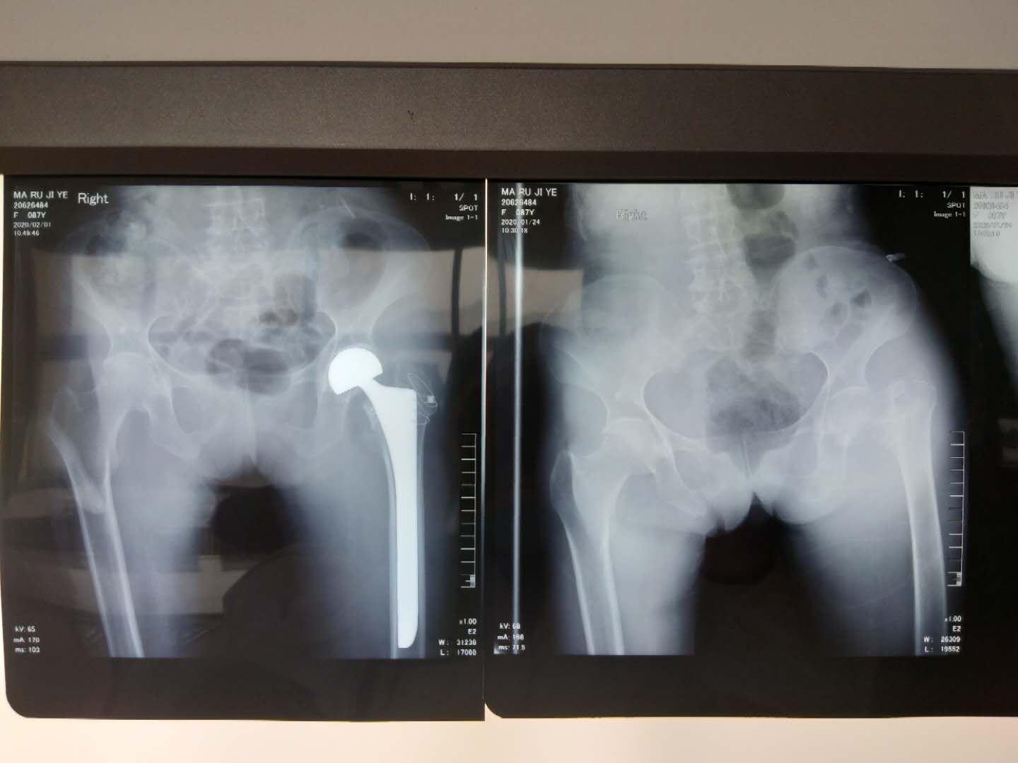 人生最后一次骨折如何挽救,为什么叫人生最后一次骨折