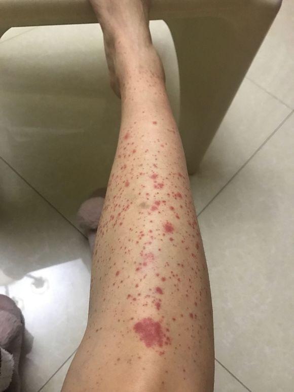 长春中医治疗肾脏病哪个医院好,肾脏病经方论治