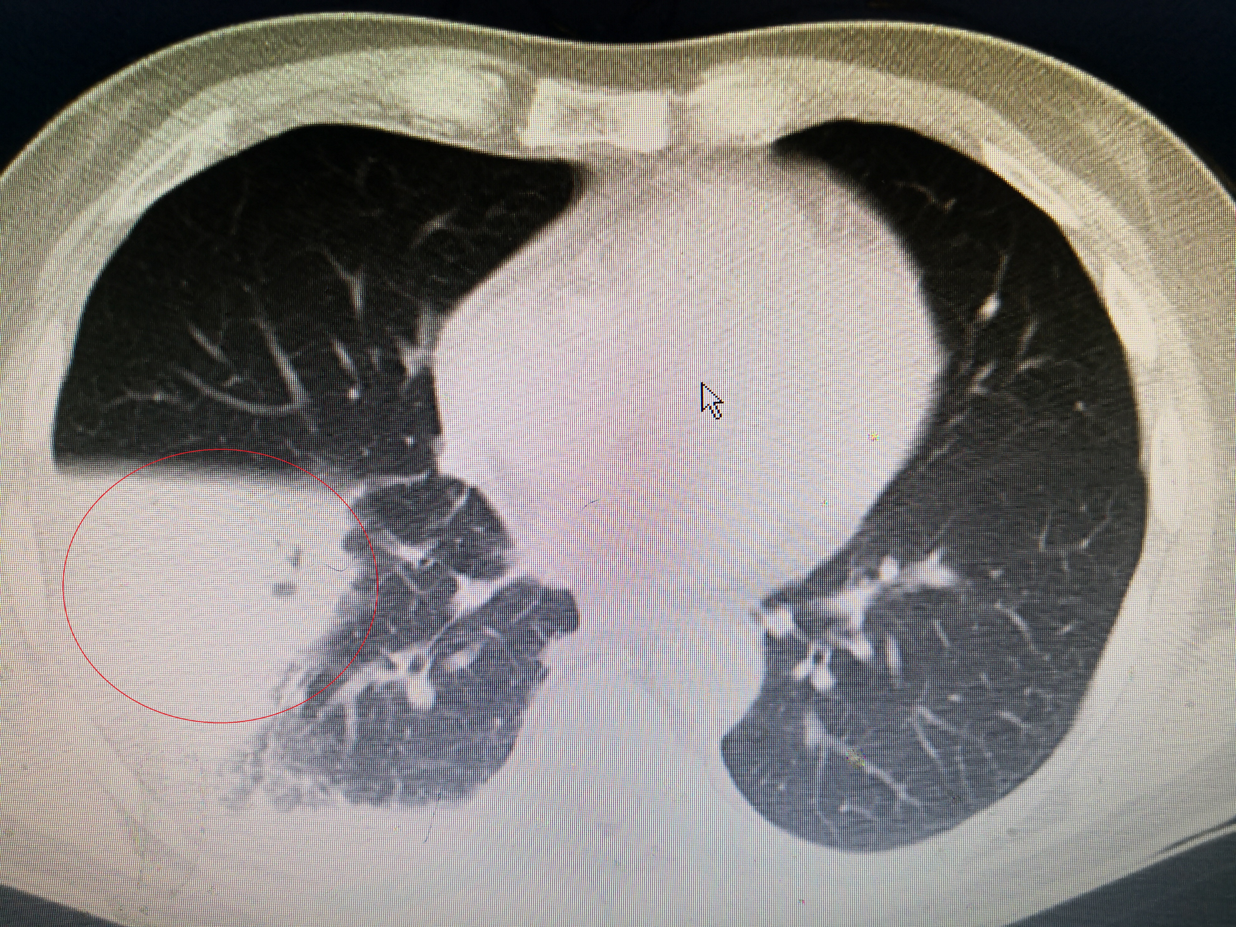 重症肺炎的急救配合要点,重症肺炎针对性护理措施