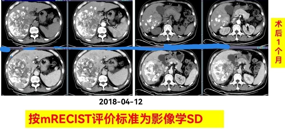 肝癌晚期靶向治疗怎么做,中国肝癌tace治疗展望