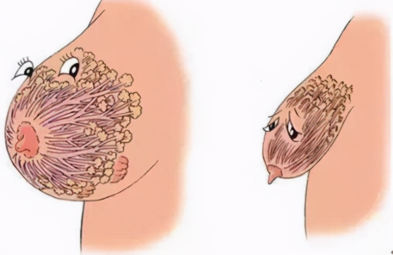 产后胸部严重松软下垂,产后喂母乳怎么防止胸部下垂