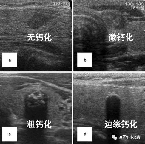 甲状腺结节术后确诊甲状腺癌,甲状腺癌为什么不用ct确诊