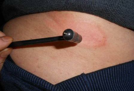 带状疱疹看中医还是看西医好,带状疱疹看中医西医