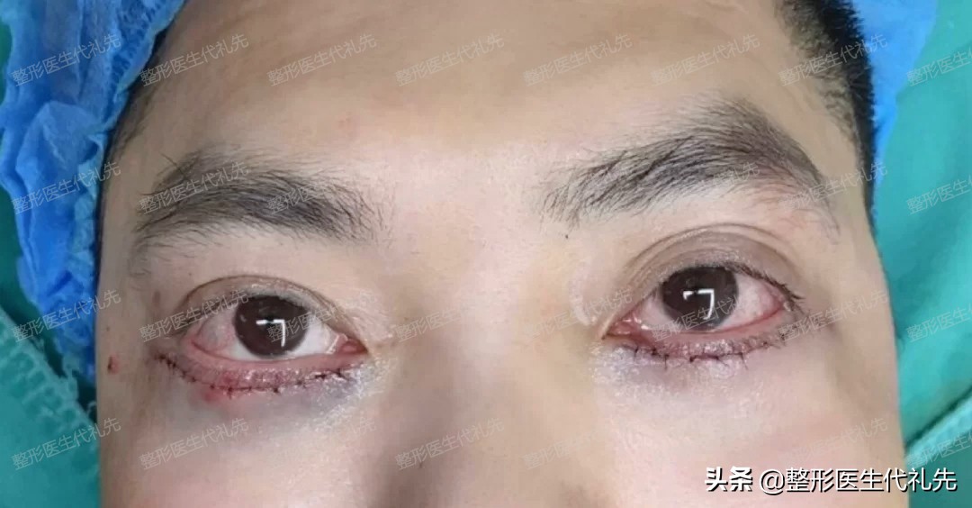 眼周年轻化手术图片,眼周年轻化什么项目