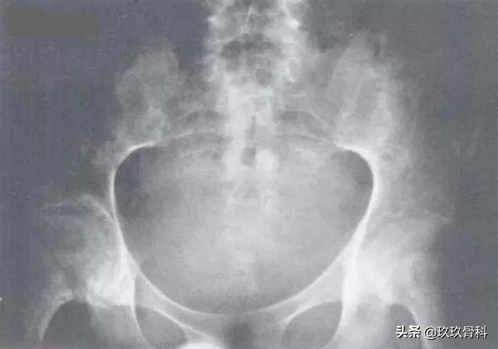 5岁小孩强直性脊柱炎的诊断,强直性脊柱炎诊断标准b27