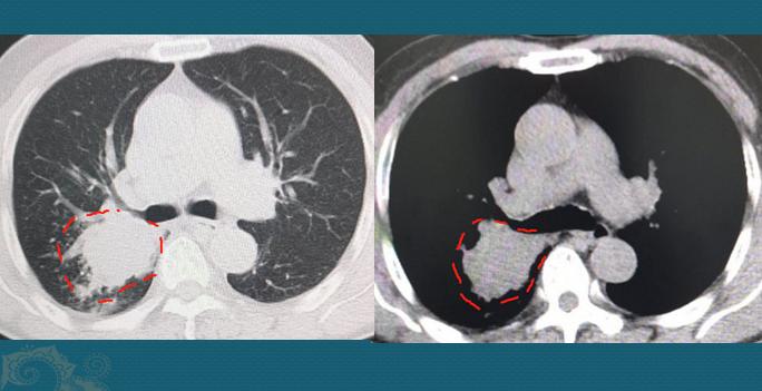 肺癌晚期和肝癌晚期哪个严重,肺癌开始到晚期需要多长时间