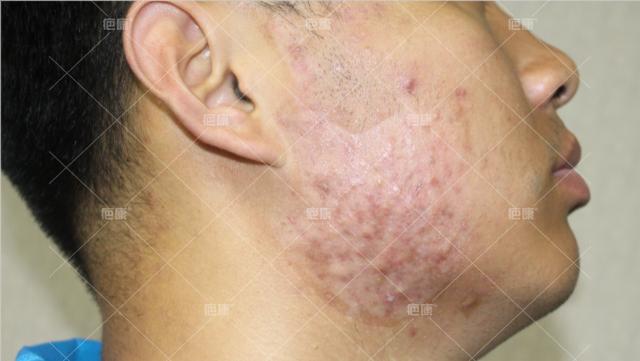 疤康治疗疼吗,疤康恢复过程视频