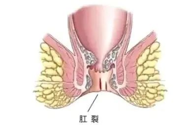 怎么知道肛裂有没有并发症,怎么知道肛裂有没有痊愈